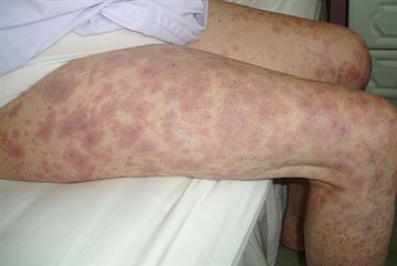 Diagnosis of cutaneous vasculitis