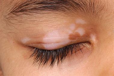Vitiligo on right upper eyelid