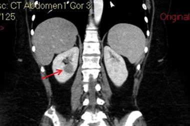 CT showing a lesion on the right kidney