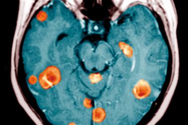 Coloured axial MRI showing brain metastases