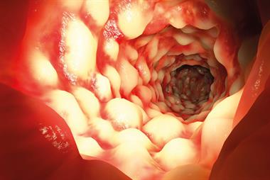 Clinical review of ulcerative colitis: epidemiology, diagnosis and