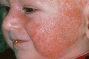 Food allergy can cause eczema (above), asthma and rhinitis (Photograph: SPL)