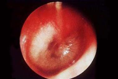 In acute otitis media the ear drum will become red and bulging and may rupture to allow pus to discharge