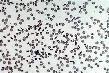 Blood film of a patient with sickle cell disease, with sickle cells, target cells and signs of hyposplenism (Photograph: Dr Patel)