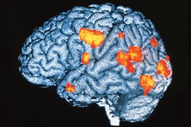 Coloured PET scan of schizophrenia patient's brain during hallucination (orange areas: brain activity) (Photograph: SPL)