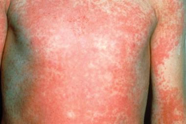 Scarlet fever rash develops 24 to 48 hours after the fever starts (Photograph: SPL)
