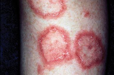 Discoid lupus erythematosus can cause atrophy and scarring (Photograph: SPL)