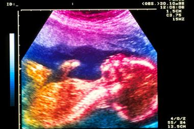 Ultrasound of a mid-term pregnancy, iron supplementation in mild anaemia may not benefit the mother