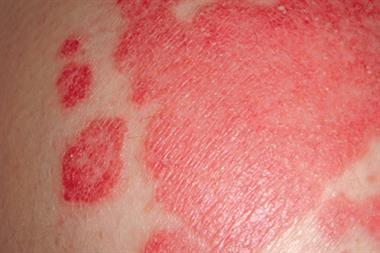 management of psoriasis in primary care