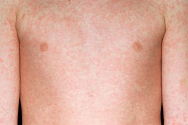 Measles rash on a 10 year old boy's upper body (SPL)