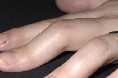 Rheumatoid arthritis typically affects small joints such as the hands