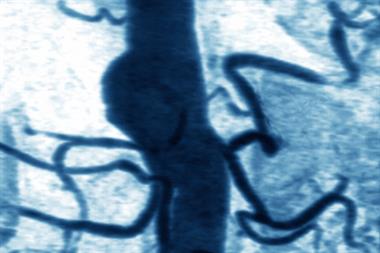 MRI scan showing an aneurysm of the abdominal aorta at the level of the kidneys (Photograph: SPL)