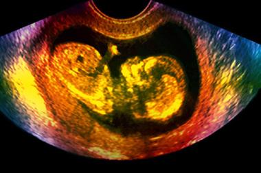 Ultrasound scan of a 37-week old fetus; movements vary from about four to 100 per hour (Photograph: SPL)
