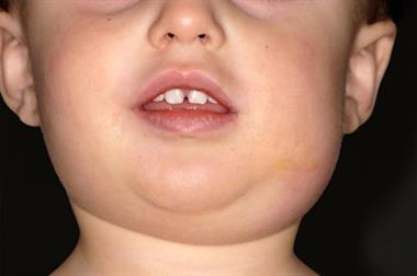 Unilateral mumps: children in the age range four to 15 years are at highest risk of contracting the virus (Photograph: SPL)