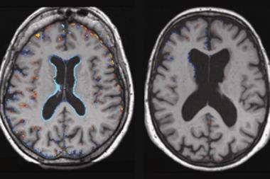 MRIs of brain tissue contraction (blue) in: i) placebo-treated patient and ii) patient treated with B vitamins (Photograph: AD Smith et al)
