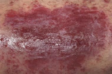 Cellulitis may result from overuse of injection sites