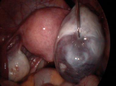 Ovarian cyst: cysts may be pregnancy or non-pregnancy related