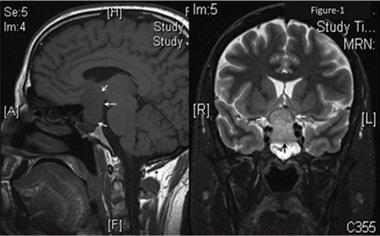 MRI showing a large pituitary adenoma (arroows) with upward extension, impinging on the optic chiasm