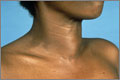 In Hashimoto’s thyroiditis may be markedly enlarged, in many cases causing a visible goitre