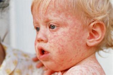 Measles: GPs warned about outbreaks in traveller communities (Photo: SPL)