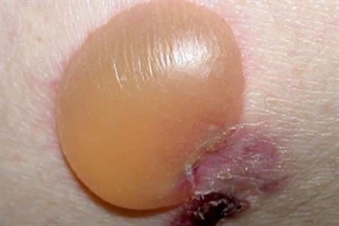 Over time the tense blisters can become purulent and haemorrhagic