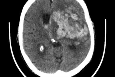 Without brain imaging, such as CT scanning, it is impossible to determine whether a stroke is ischaemic or haemorrhagic (above) (Photograph: Dr Jonathan Birns)
