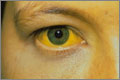 Yellowing of the sclera (GARRY WATSON / SCIENCE PHOTO LIBRARY)