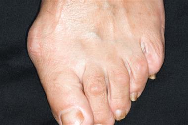 Hallux valgus (shown above) presents with a bunion over the great toe, which is angled laterally (Photograph: SPL)
