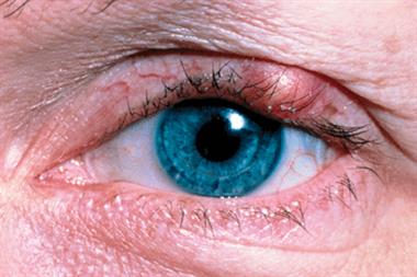 Stye (hordeolum) on patient's upper eyelid (Photograph: SPL)
