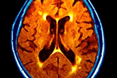 Dementia damage on MRI scan
