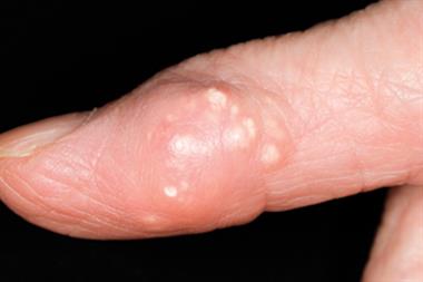 Gout tophus on the finger of 90-year-old female patient (Photograph: SPL)