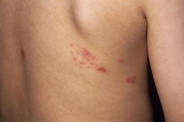 Shingles: a possible risk factor