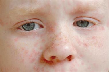 Antivirals are not always indicated for cases of chickenpox (Photograph: Guillaume / Science Photo Library)