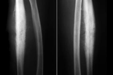 Frontal (left) and profile (right) X-rays of the forearm of a 12 year-old with Ewing's sarcoma