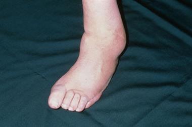 Deformity to foot and ankle due to neuropathy