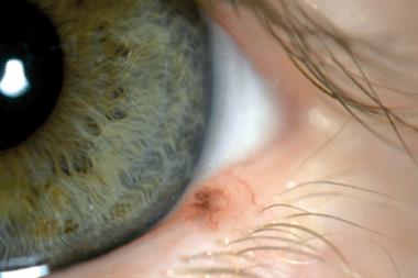 The patient's optician noted a small lesion inside her left lower eyelid (Photograph: Author image) 