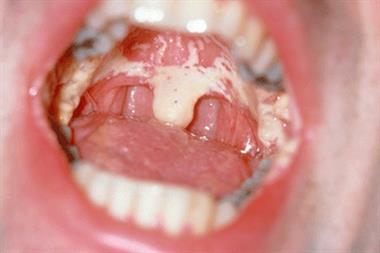 Mouth conditions such as oral candidiasis may indicate HIV (Photograph: St Mary's Hospital Medical School / Science Photo Library)