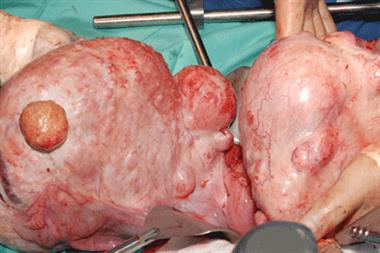 Uterine fibroids: incidence increases with increasing age 
