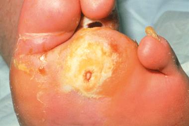 Infected ulcers (shown above) should be cultured for aerobic and anaerobic bacteria (Photograph: SPL)