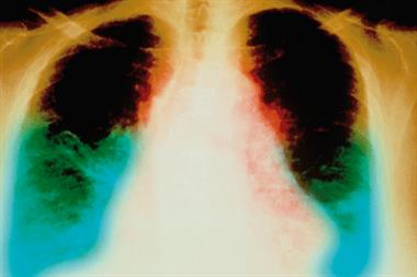 Heart failure: risk factor prediction models have limited accuracy (Photograph: SPL)