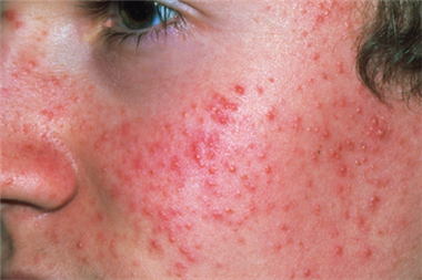 Acne: inflammatory lesions