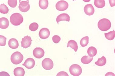 HELLP: severe haemolysis with irregular, damaged red blood cells (Photograph: D Roberts and J Burthem)
