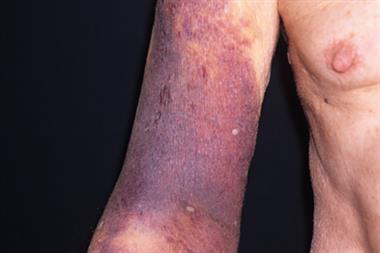 Bruising in the arm of an 80-year-old woman taking warfarin (Photograph: SPL)