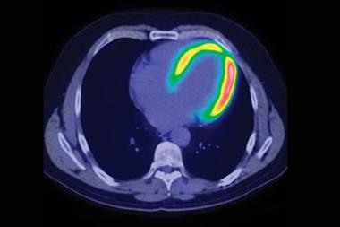 CT-PET scan of a patient with heart failure; overweight type-2 diabetics were not at greater risk of death (Photograph: SPL)