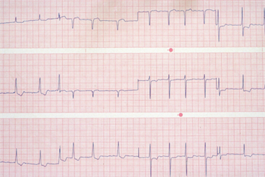 Electrocardiogram (EKG) depicting atrial fibrillation