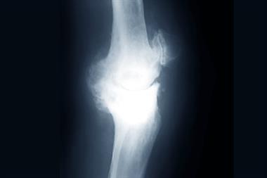 Osteoarthritis of the knee: studies failed to show any marked reduction in pain in patients taking glucosamine 
