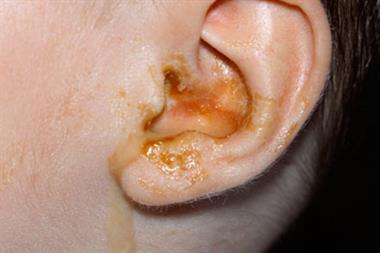A glue ear typically occurs following an episode of inflammation (Photograph: SPL)