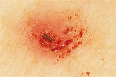 After a tick bite, an asymptomatic or slightly itchy erythematous rash appears