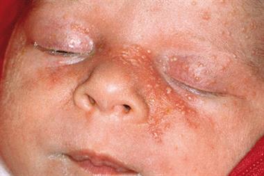 Sebaceous gland hyperplasia in newborns will resolve spontaneously 