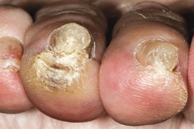 Onychomycosis affects toenails more commonly than fingernails (Photograph: Author Image)